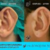 Otoplastia Secundaria - Joaquim Suñol