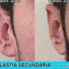 Otoplastia Secundaria - Joaquim Suñol