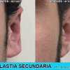 Otoplastia Secundaria - Joaquim Suñol