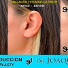 Reduccion del tamaño de las Orejas - Joaquim Suñol