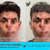 Otoplastia Secundaria con Reduccion del tamaño de las Orejas - Joaquim Suñol
