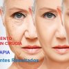 Ultherapia - Dr. Galo Mauricio Solano Quinde