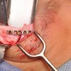 tumor de orbita en paciente pediatrico - Eduardo Alvarado