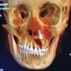 Tumor Odontogenico Adenomatoide (T.O.A.) - Eduardo Alvarado