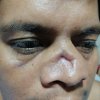fractura nasal complicada - Eduardo Alvarado