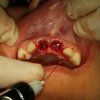 implantes dentales - Eduardo Alvarado