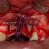 distraccion osteogenica - Eduardo Alvarado