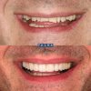 Carillas de Disilicato - Clínica Palma Medicodental