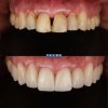 Carillas de Composite - Clínica Palma Medicodental