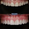 Carillas de Disilicato - Clínica Palma Medicodental