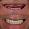 Rehabilitación completa con implantes de carga inmediata - Clínica Palma Medicodental