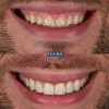 Carillas de Composite - Clínica Palma Medicodental