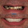 Rehabilitación completa con implantes de carga inmediata - Clínica Palma Medicodental