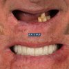 Rehabilitación completa con implantes de carga inmediata - Clínica Palma Medicodental