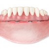 Dentadura hibrida sobre implantes - Clínica Dental Basi