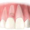 Corona de porcelana sobre implante - Clínica Dental Basi