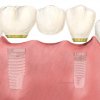 Puente sobre implantes - Clínica Dental Basi