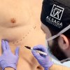 Marcaje preoperatorio. - Alberto Sánchez García
